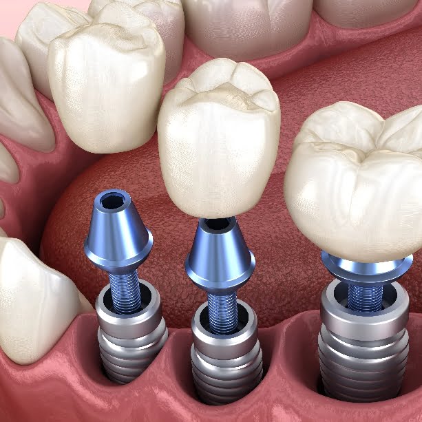 3 tooth crowns placement over 3 implants - concept