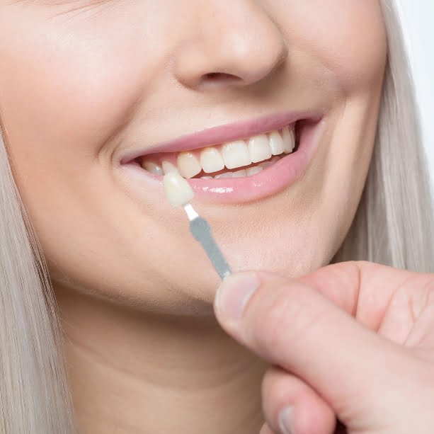 Using a shade guide at womans mouth to check veneer of tooth crown