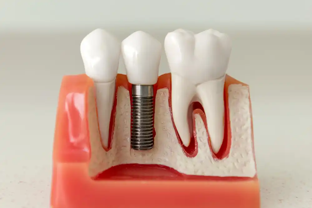 Understanding Dental Implants: A Comprehensive Guide for Chicago Residents