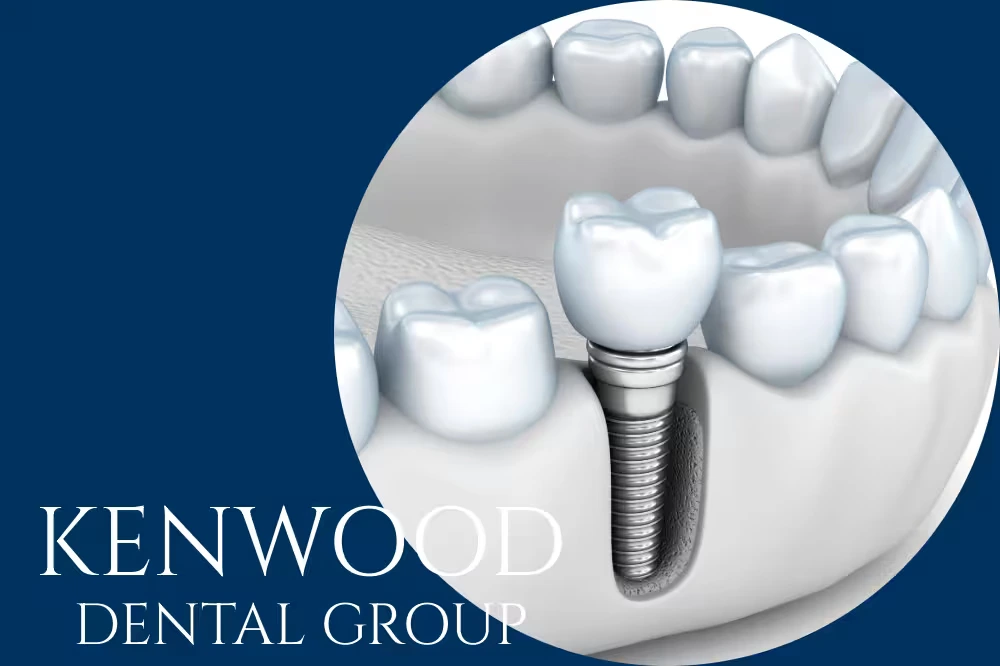 How Dental Implants Can Restore Your Confidence: Dentist in Chicago, IL, Explains